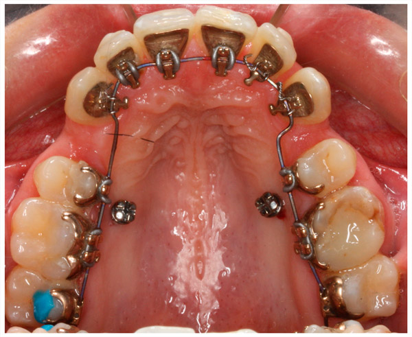 microimplantes en ortodoncia