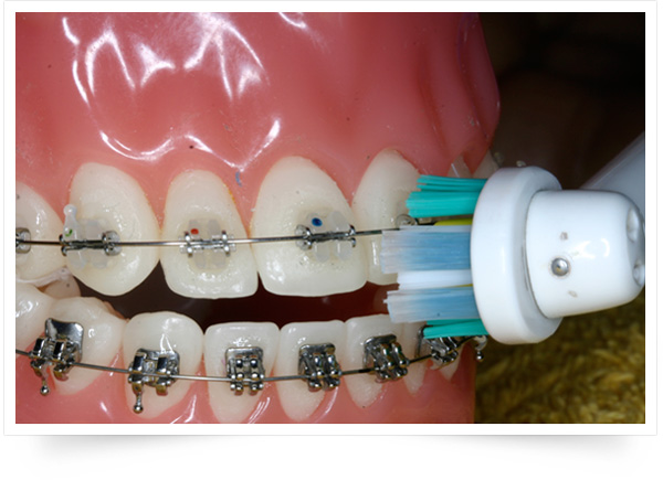 ortodoncia cepillar dientes