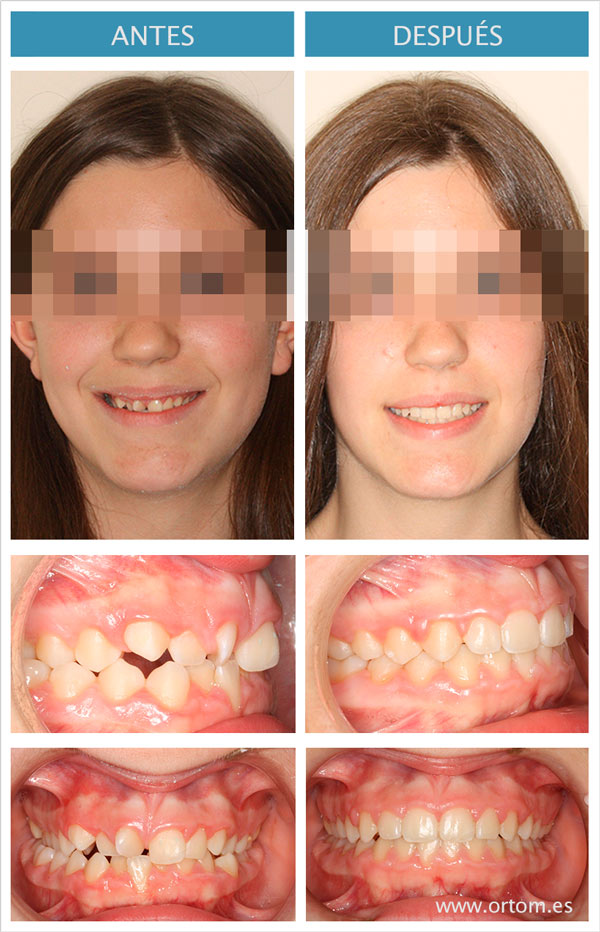 ortodoncia estetica invisalign