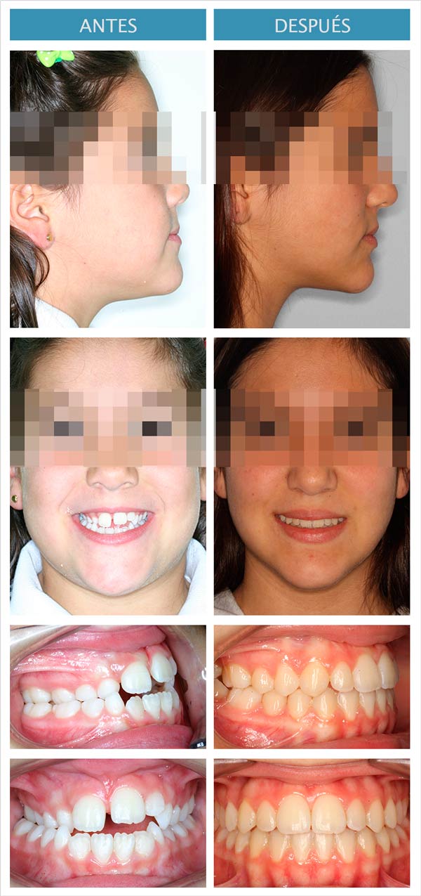 ortodoncia infantil clase 3