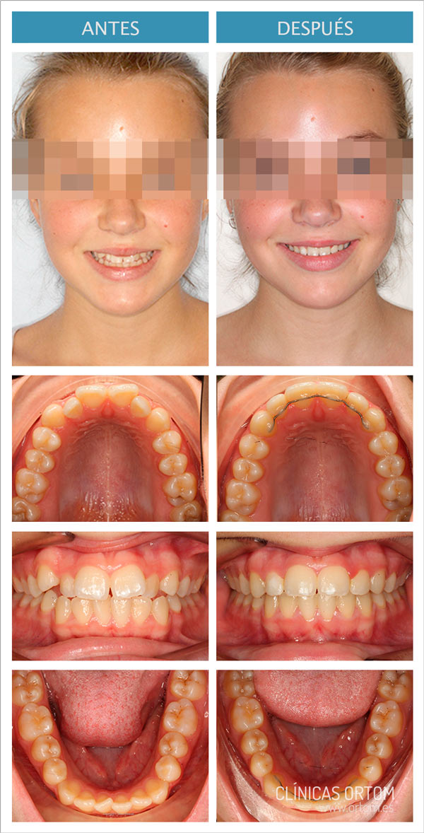 ortodoncia: brackets damon clase-III
