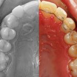 caso de ortodoncia estética invisalign