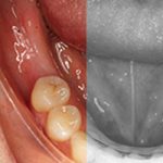 perdida de dientes ortodoncia madrid