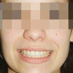 Sonrisa gingival y ortodoncia