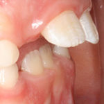 caso de ortodoncia en niños: mandíbula pequeña