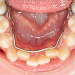 Ortodoncia interceptiva ortom madrid