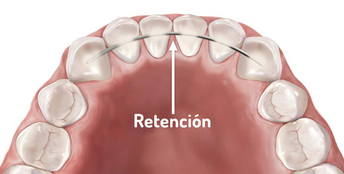 retenedores de ortodoncia