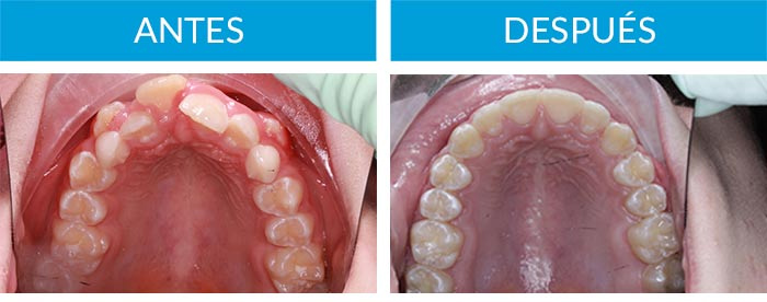 caso de ortodoncia infantil adolescente