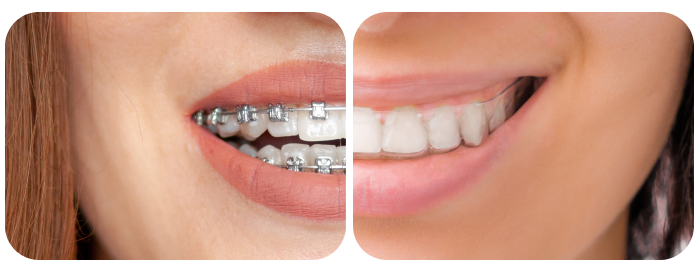 Brackets vs ortodoncia invisible