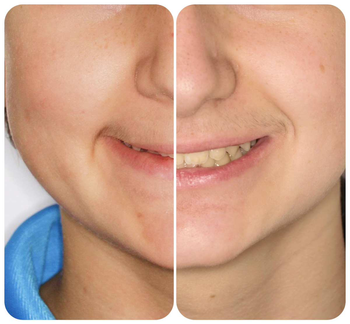 ¿Se puede utilizar la ortodoncia invisible en niños o adolescentes?